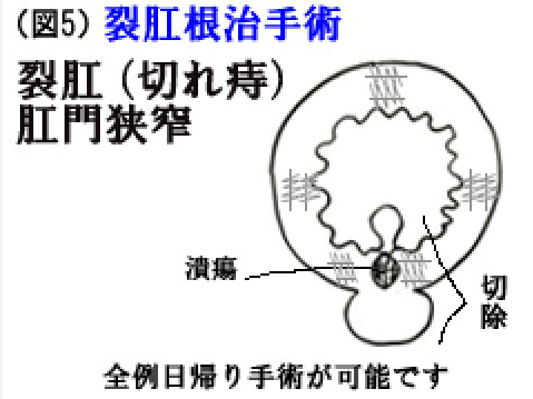 裂肛根治手術